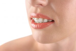 Clear Braces in Palm Beach Gardens, FL