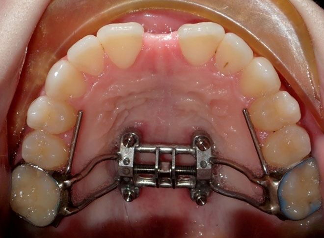 Adult Airway